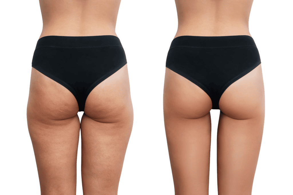 Des fesses plus fermes avec l'EMS électrostimulation